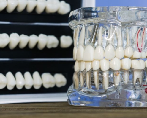 leczenie kanałowe czy implant