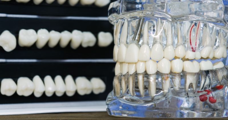 leczenie kanałowe czy implant