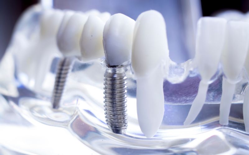 implanty zębowe