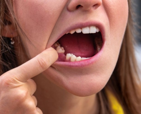 kobieta wskazuje palcem suchy zębodół