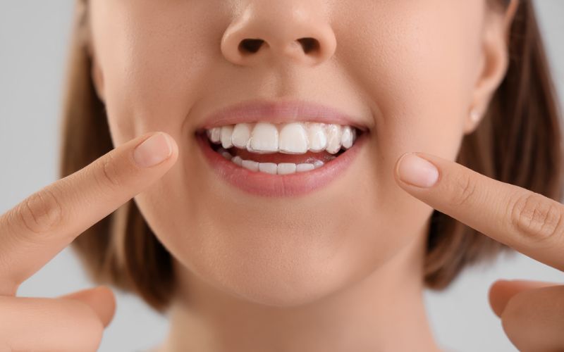 nakładki na zęby - aparat