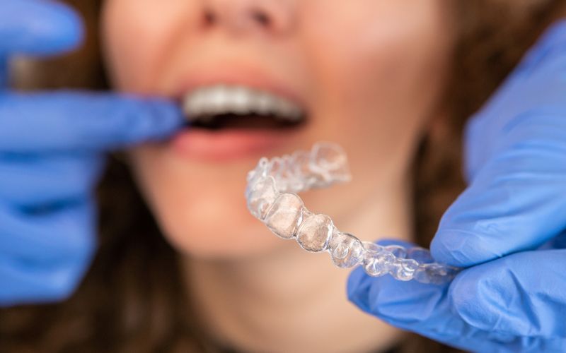 aparat invisalign