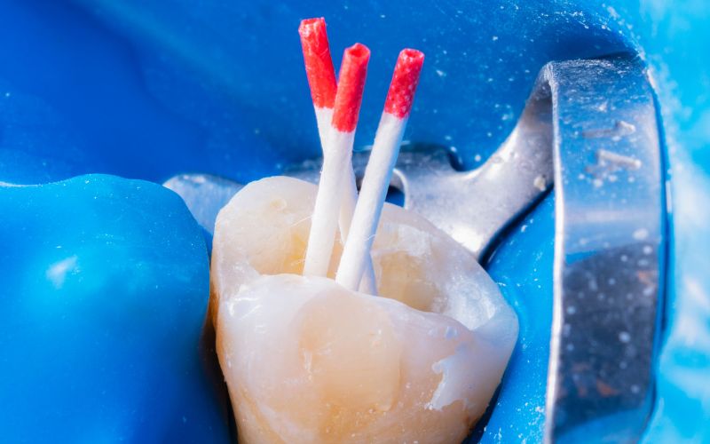 wizualizacja leczenia kanałowego