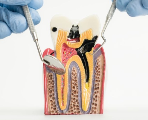 próchnica zęba - wizualizacja