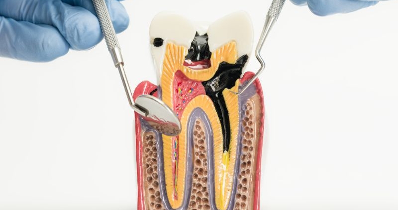 próchnica zęba - wizualizacja