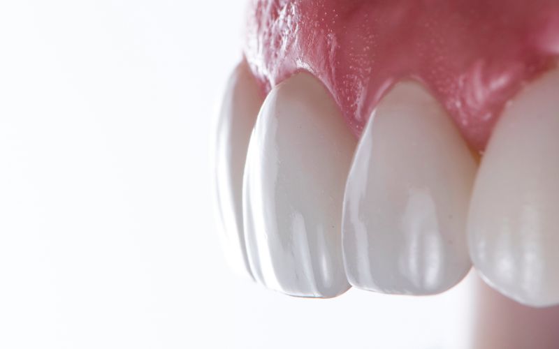 Model anatomiczny zębów z założonymi licówkami porcelanowymi.