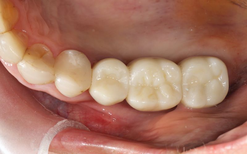 Narzędzia do czyszczenia mostów zębowych – szczoteczka, nić, irygator