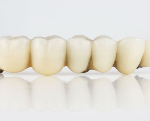 Czyszczenie mostu zębowego – nić Super Floss pod przęsłem