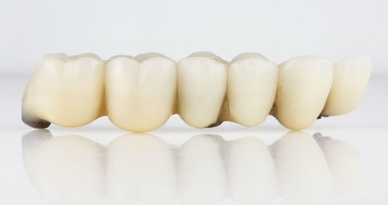 Czyszczenie mostu zębowego – nić Super Floss pod przęsłem